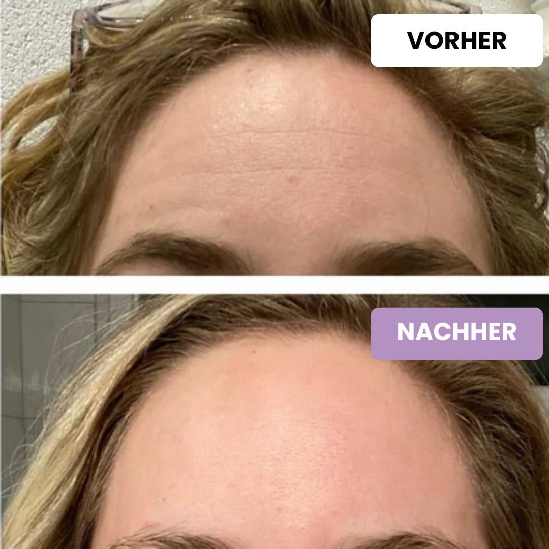 ScarAway™ | Silikon-Narbenpflaster - ShopVectura
